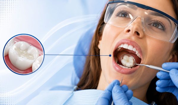Tooth-colored-fillings